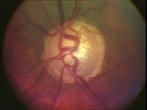 Distinct optic nerve atrophy in advanced glaucoma ...
