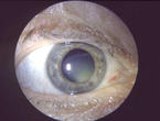 Cataract with spontaneous lens luxation 