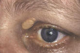 Xanthelasma – a lipotrophy in the eyelid skin.